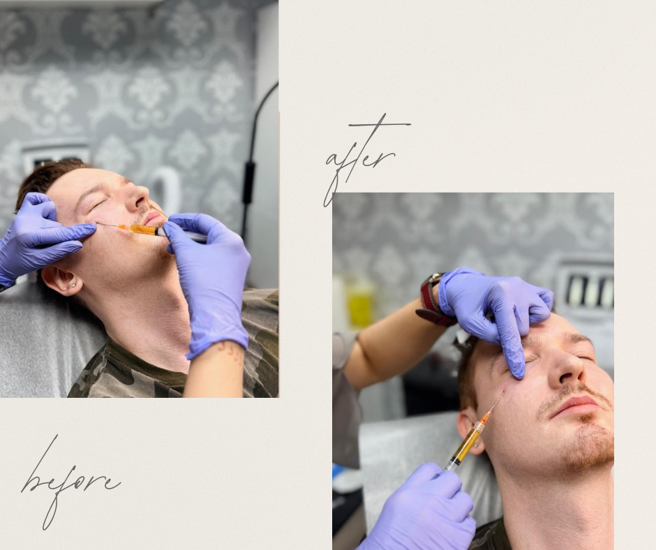 Full Face Rejuvenation Before and After