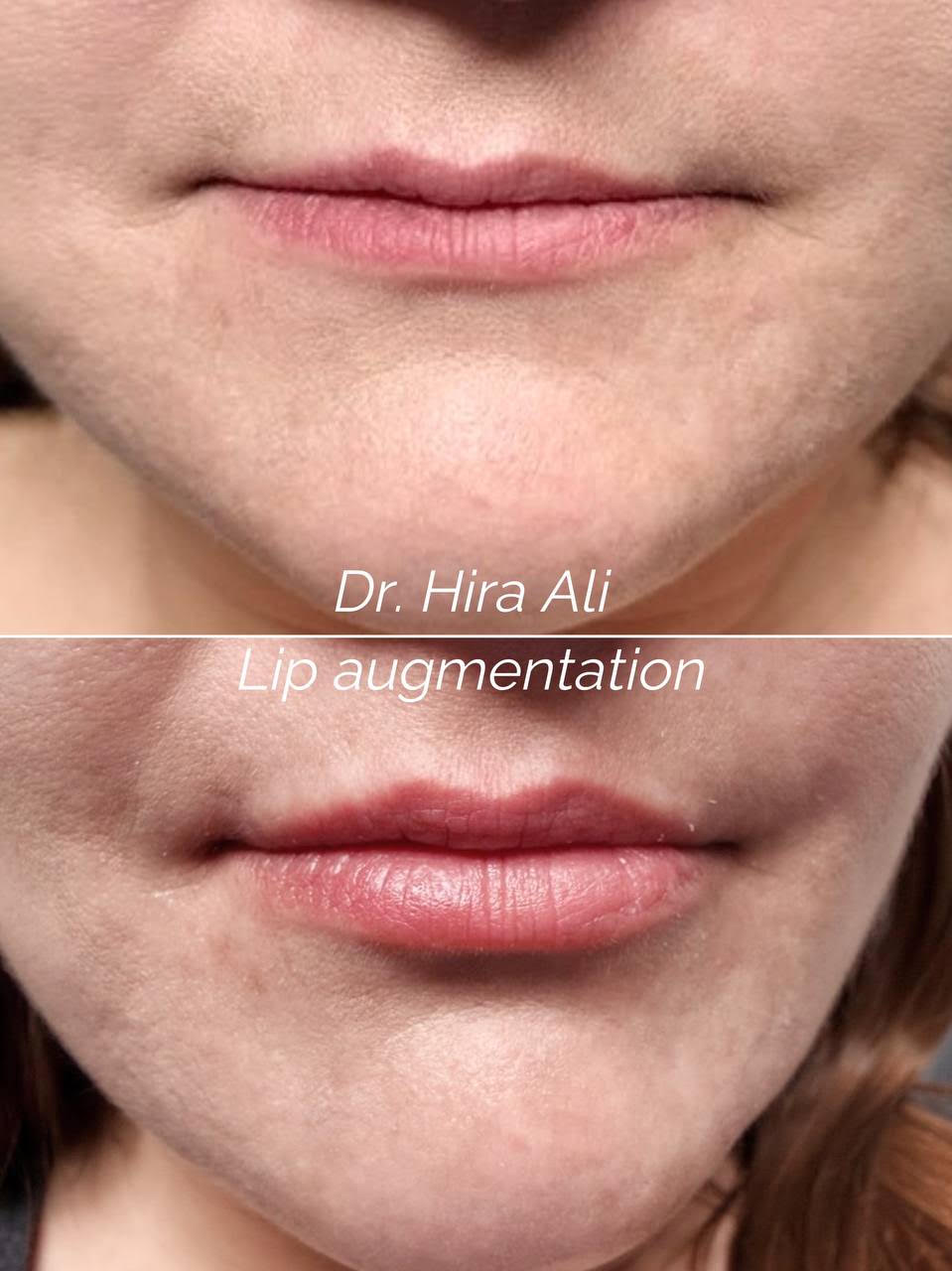 Lip Rejuvenation Before and After