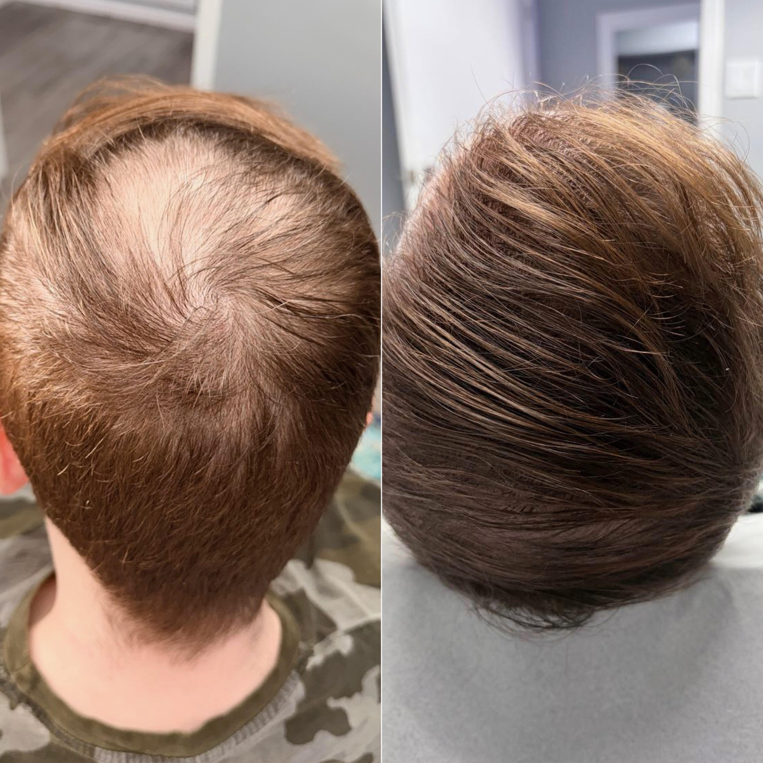 PRP Hair Treatment Before and After