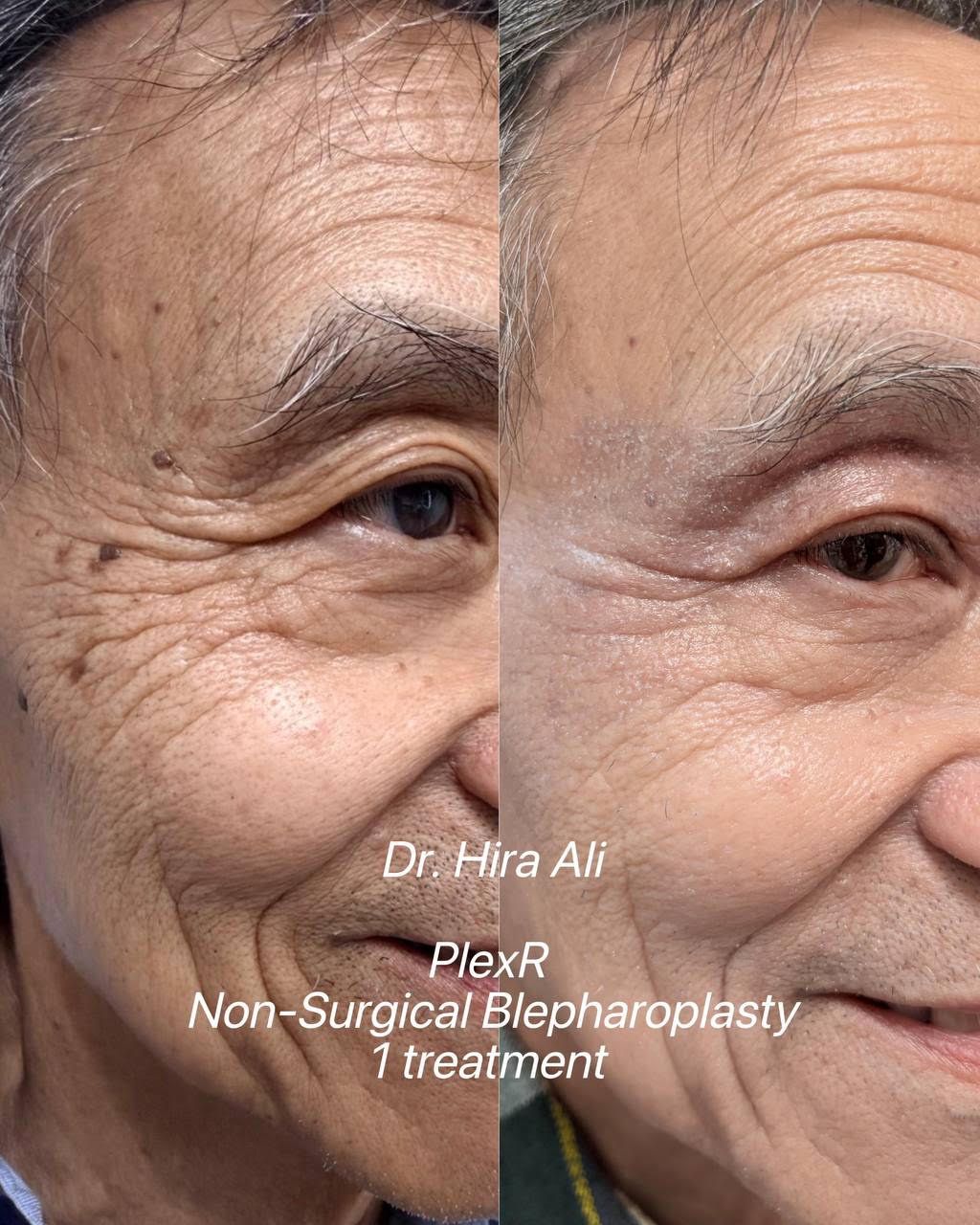 Plexr Non-Surgical Blepharoplasty Before and After