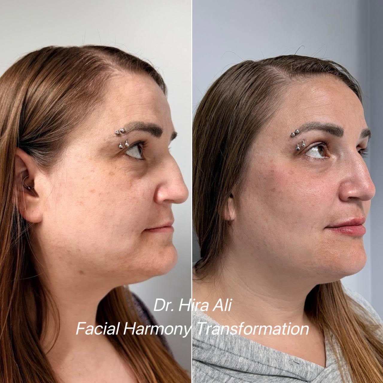 Facial Harmony Transformation Before and After